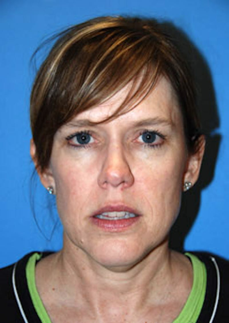 Brow Lift Before & After Gallery - Patient 598196 - Image 1