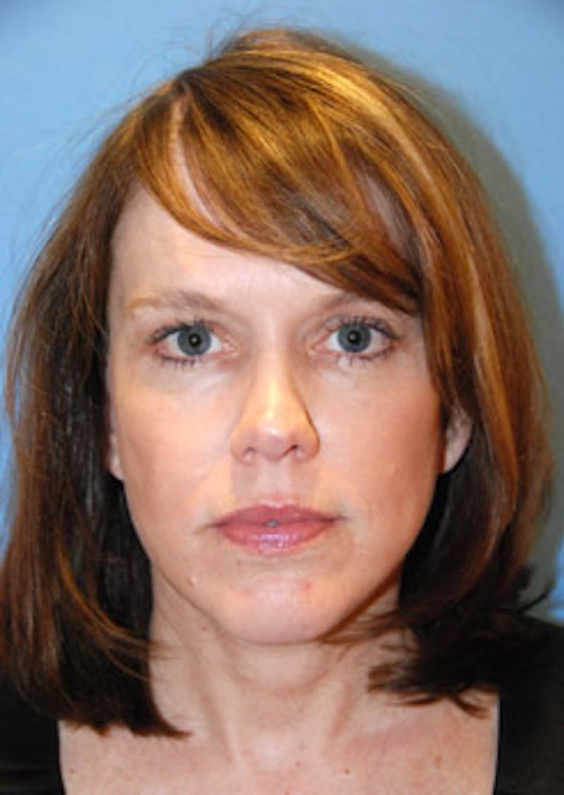 Brow Lift Before & After Gallery - Patient 598196 - Image 2