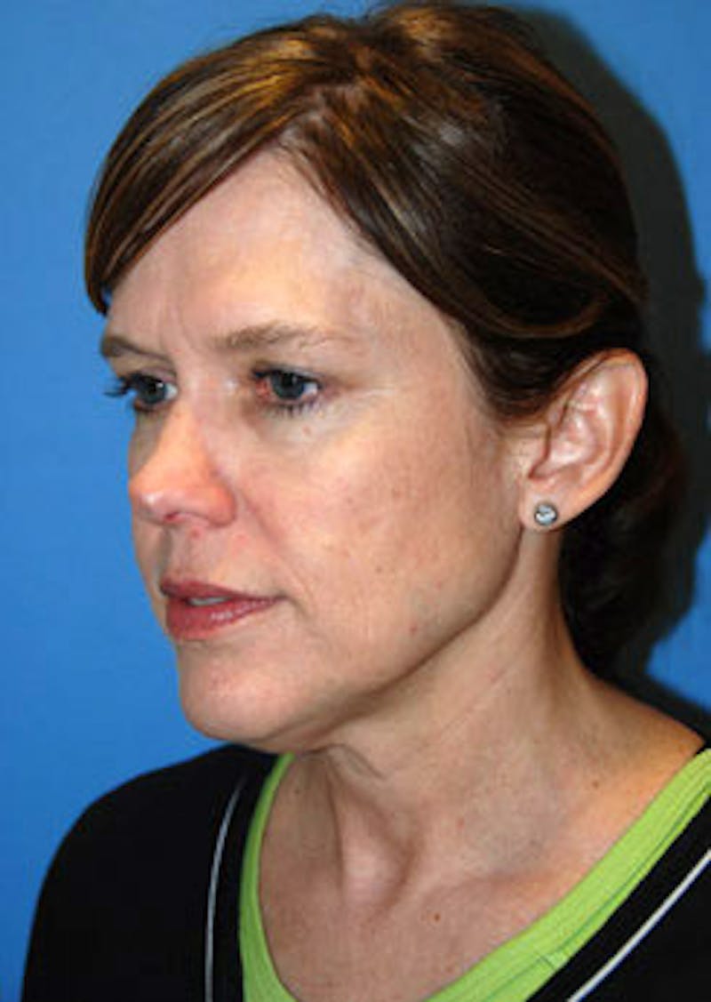 Brow Lift Before & After Gallery - Patient 598196 - Image 3