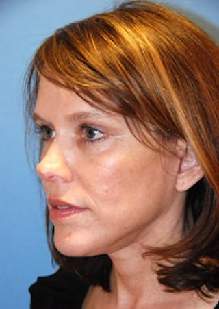 Brow Lift Before & After Gallery - Patient 598196 - Image 4