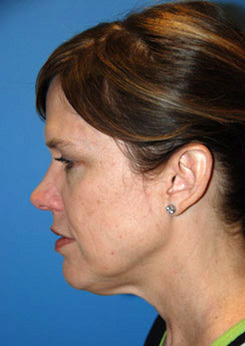 Brow Lift Before & After Gallery - Patient 598196 - Image 5