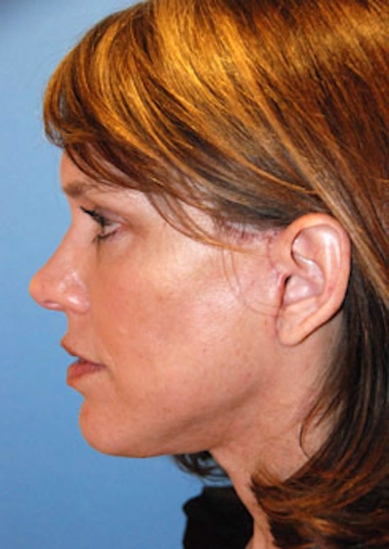 Brow Lift Before & After Gallery - Patient 598196 - Image 6