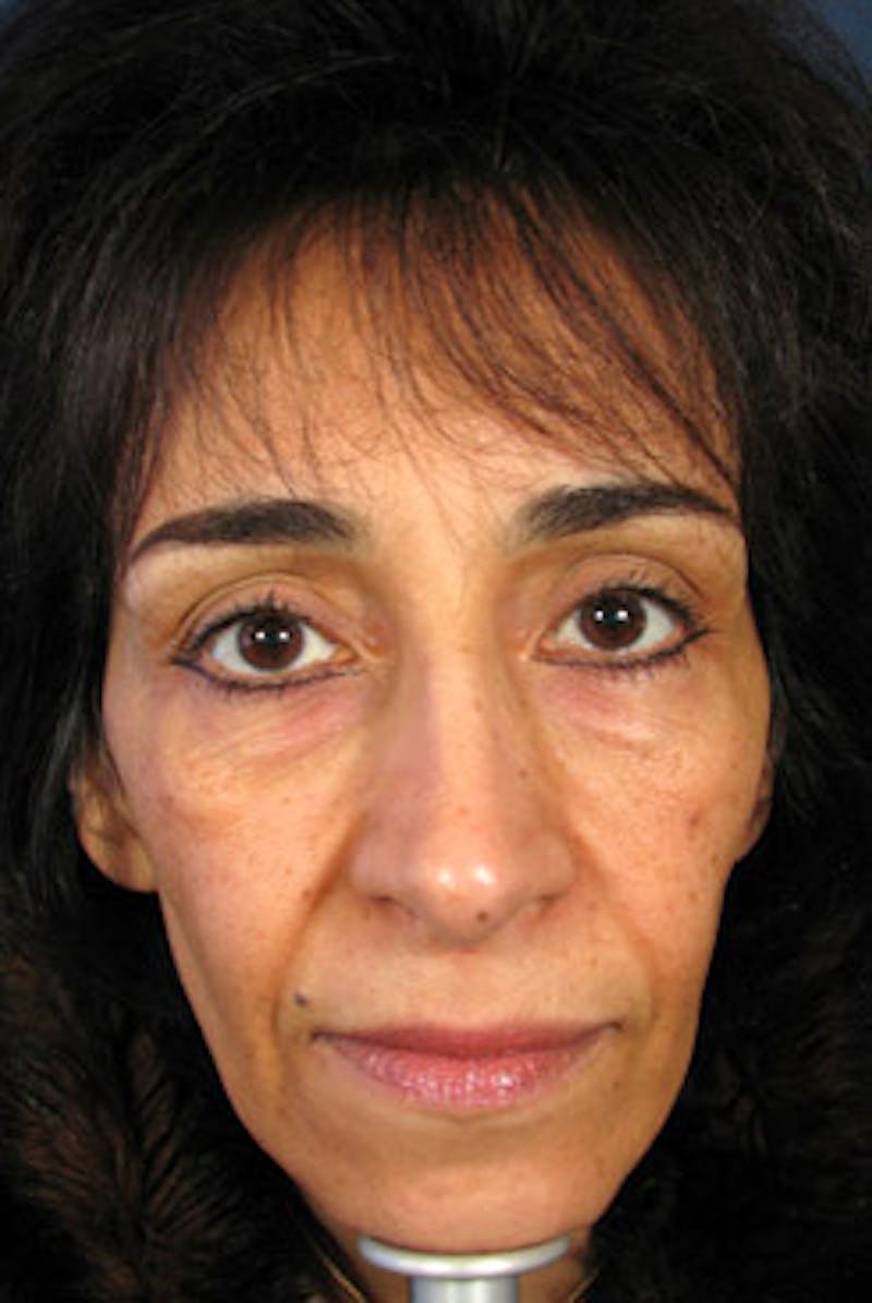 YoungVitalizer Before & After Gallery - Patient 228501 - Image 5
