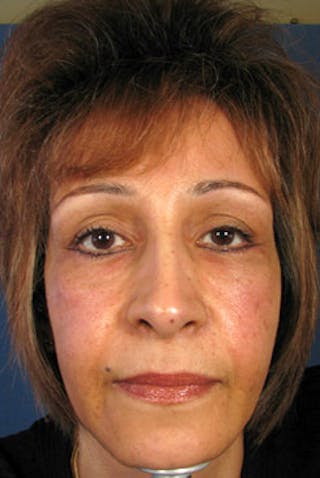 YoungVitalizer Before & After Gallery - Patient 228501 - Image 6