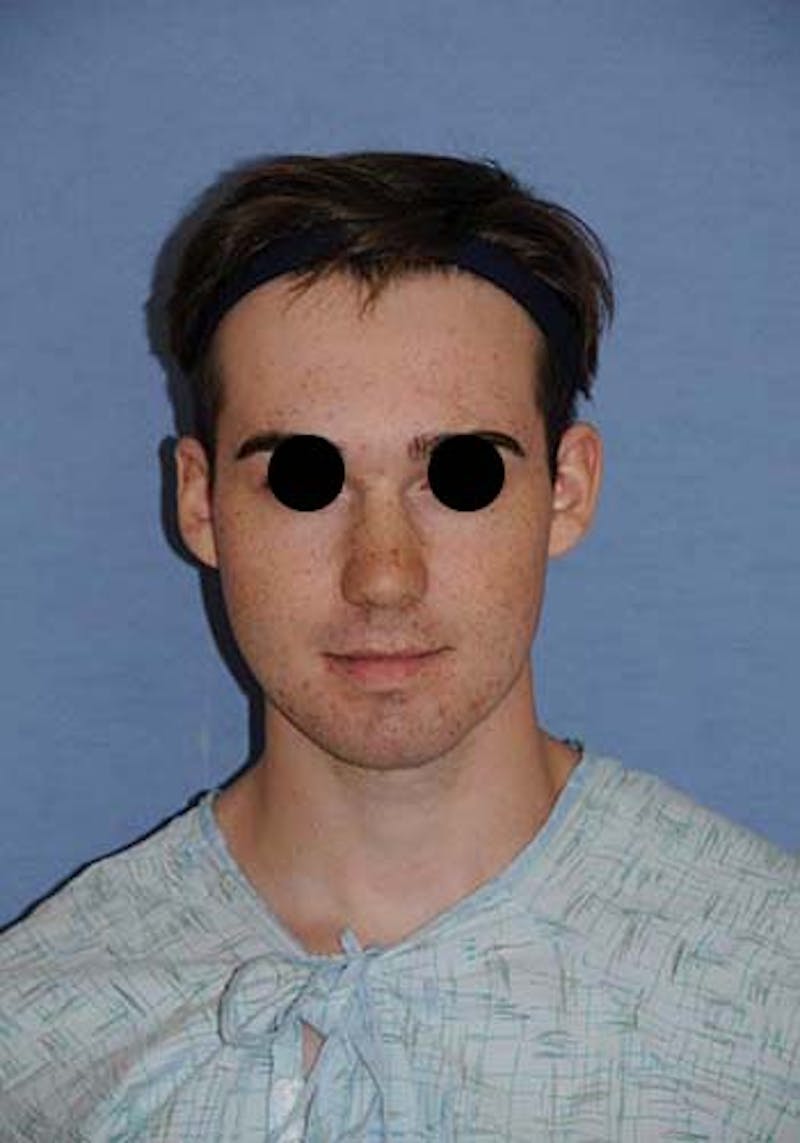 Buccal Fat Removal Before & After Gallery - Patient 687503 - Image 1