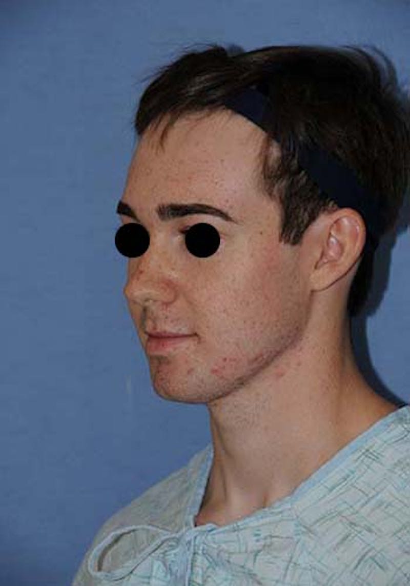 Buccal Fat Removal Before & After Gallery - Patient 687503 - Image 5