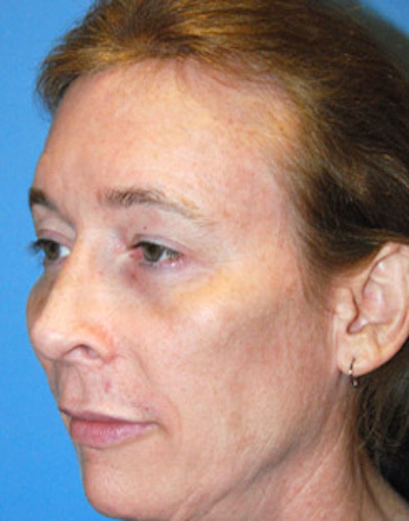 Cheek Implant Before & After Gallery - Patient 131868 - Image 6