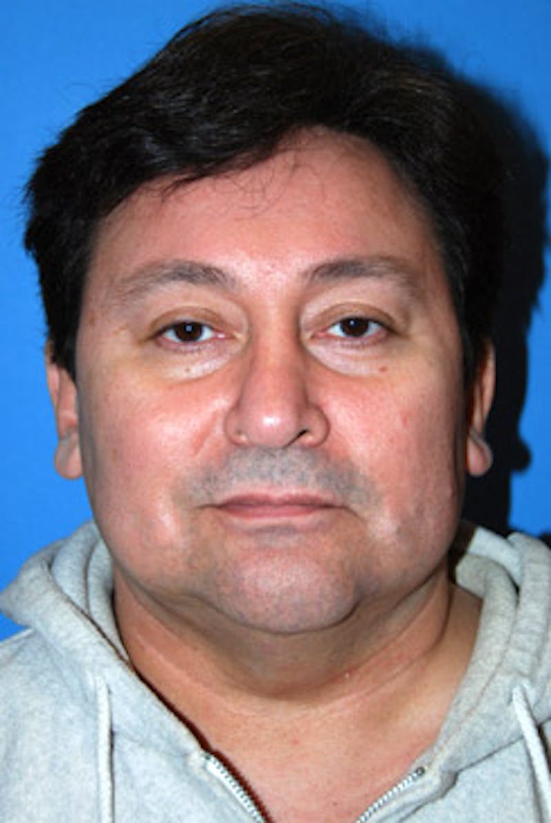 Facelift Before & After Gallery - Patient 413435 - Image 1