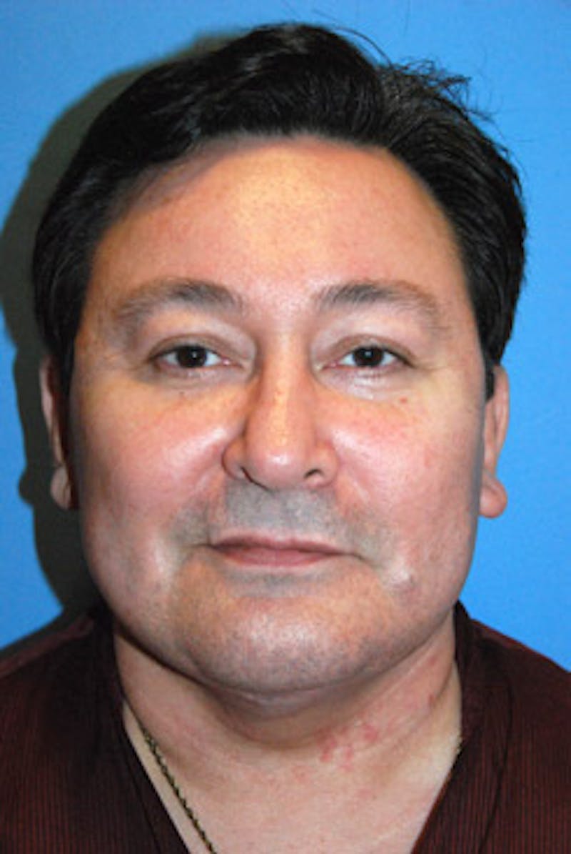 Facelift Before & After Gallery - Patient 413435 - Image 2
