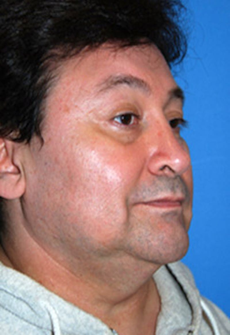Facelift Before & After Gallery - Patient 413435 - Image 3