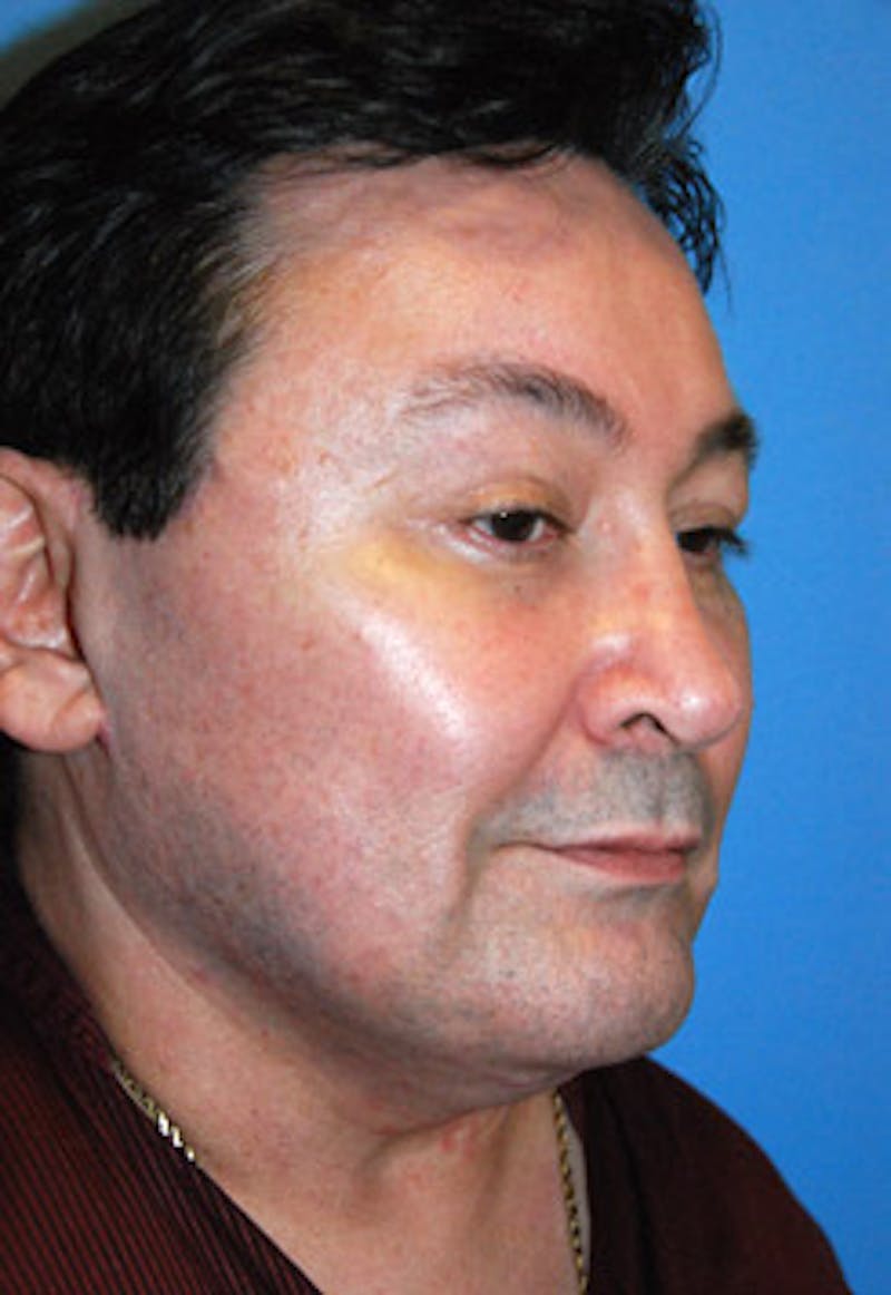 Facelift Before & After Gallery - Patient 413435 - Image 4