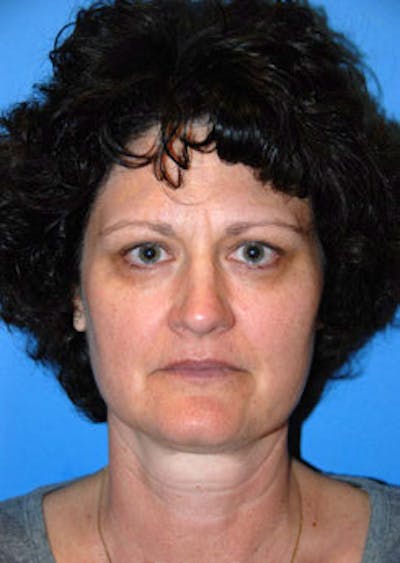 Cheek Implant Before & After Gallery - Patient 147587 - Image 1