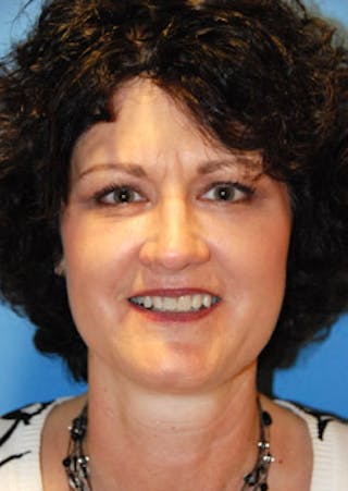 Cheek Implant Before & After Gallery - Patient 147587 - Image 2