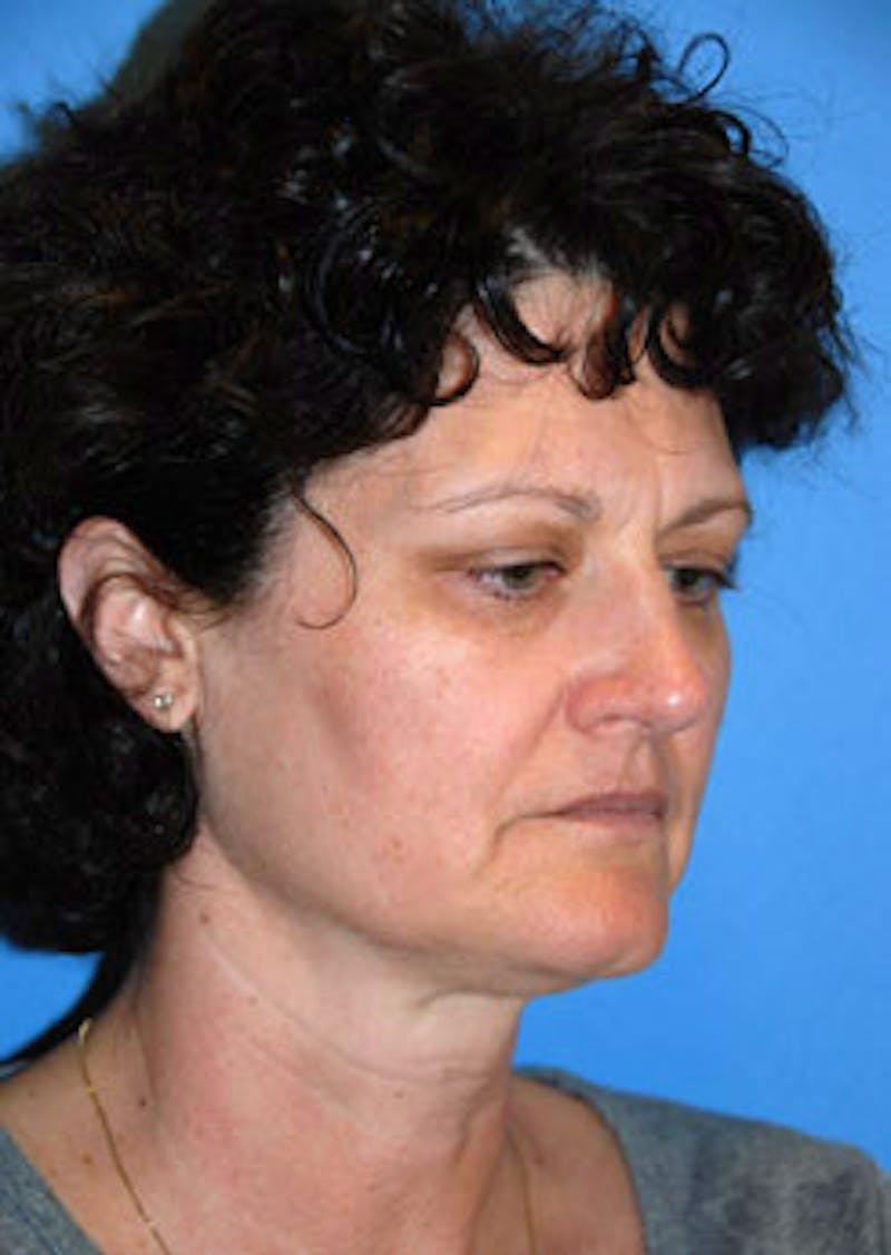 Facial Fillers / Injectables Before & After Gallery - Patient 864868 - Image 3