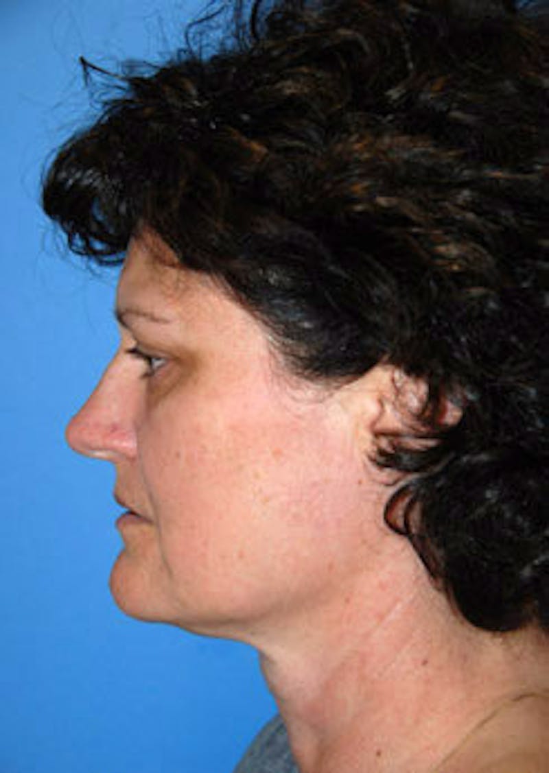 Facial Fillers / Injectables Before & After Gallery - Patient 864868 - Image 5