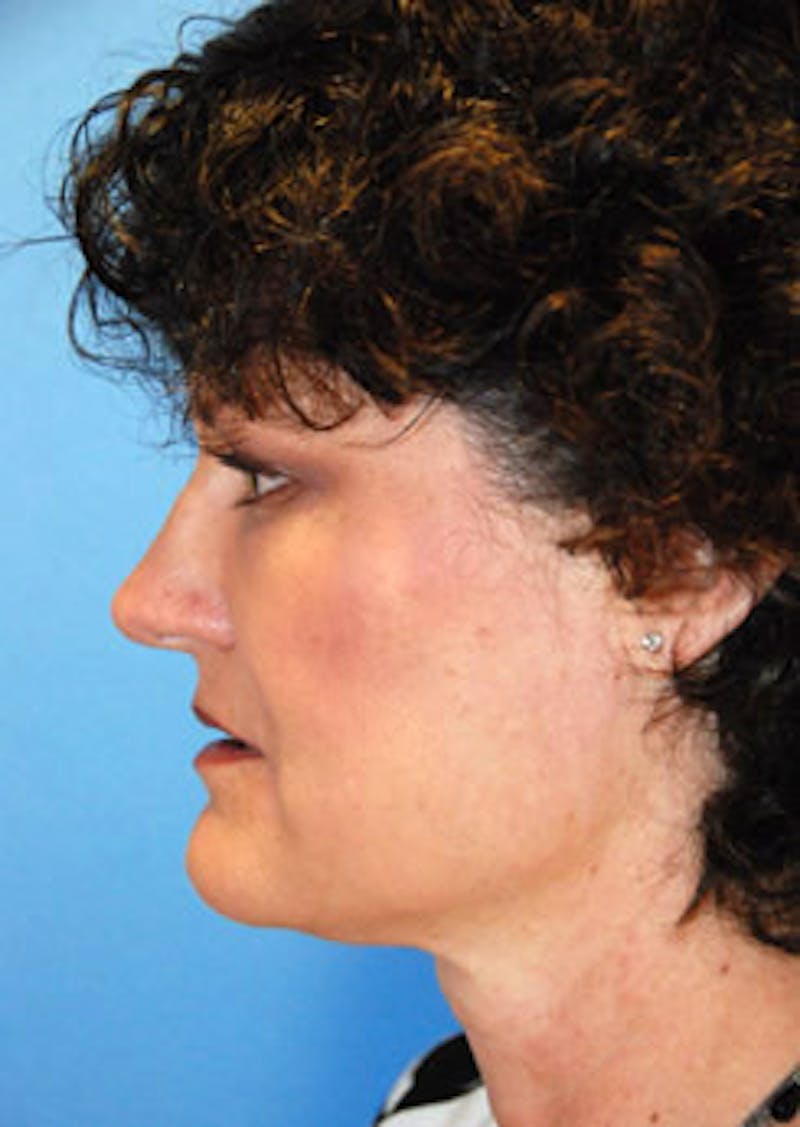 Facial Fillers / Injectables Before & After Gallery - Patient 864868 - Image 6