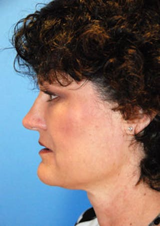 Cheek Implant Before & After Gallery - Patient 147587 - Image 6