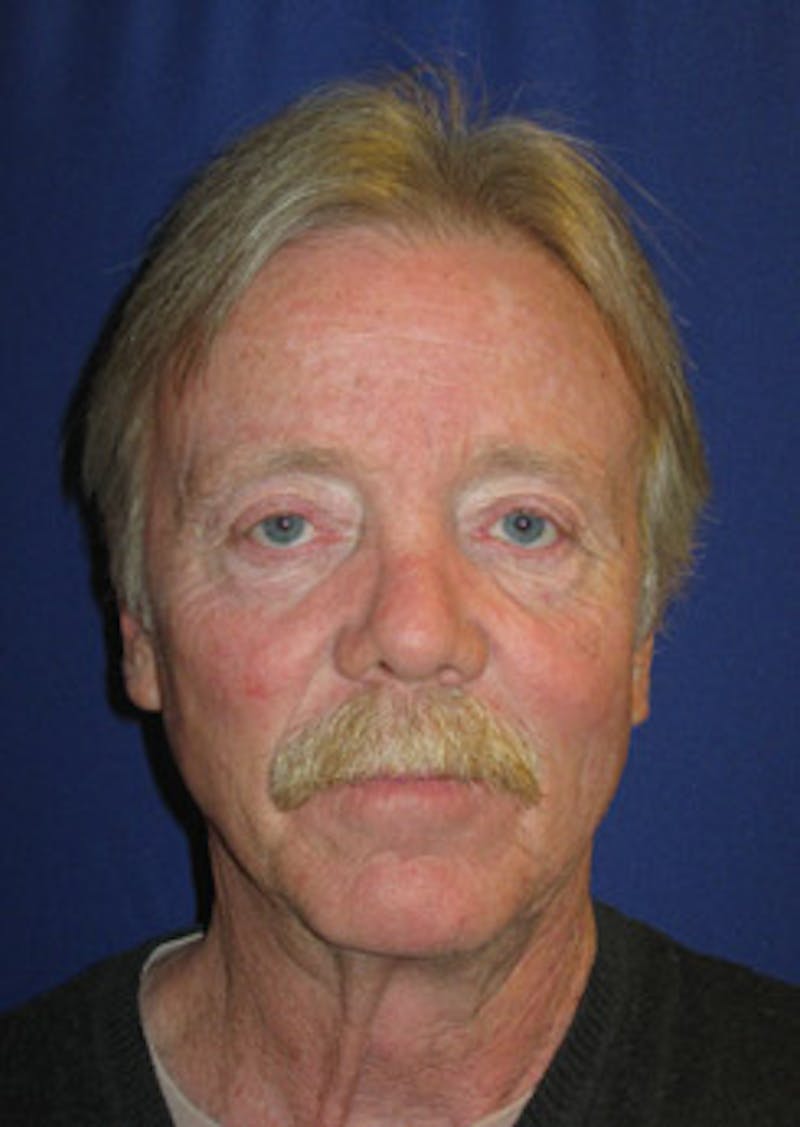 Eye Lift Before & After Gallery - Patient 394072 - Image 1