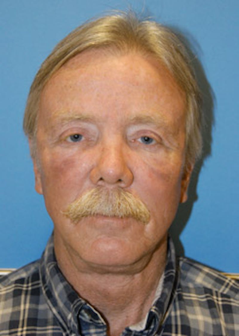 Eye Lift Before & After Gallery - Patient 394072 - Image 2