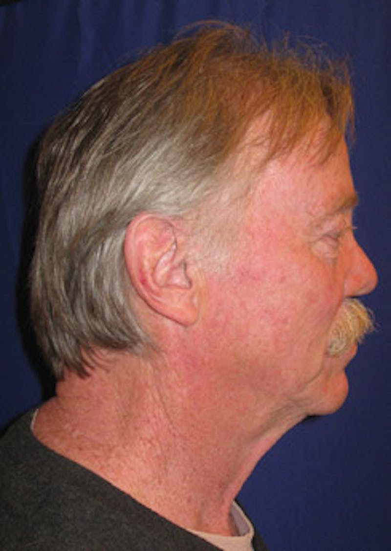 Mid Facelift Galleries Before & After Gallery - Patient 166068 - Image 1