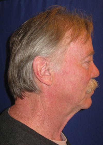 YoungVitalizer Before & After Gallery - Patient 815356 - Image 1