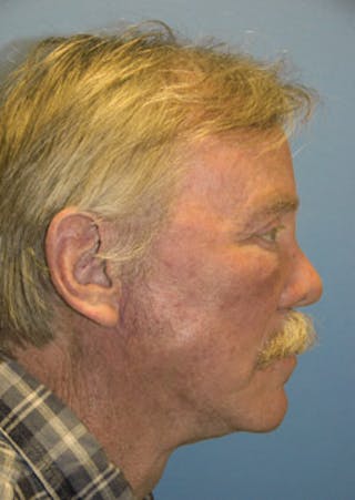 Cheek Implant Before & After Gallery - Patient 719120 - Image 4