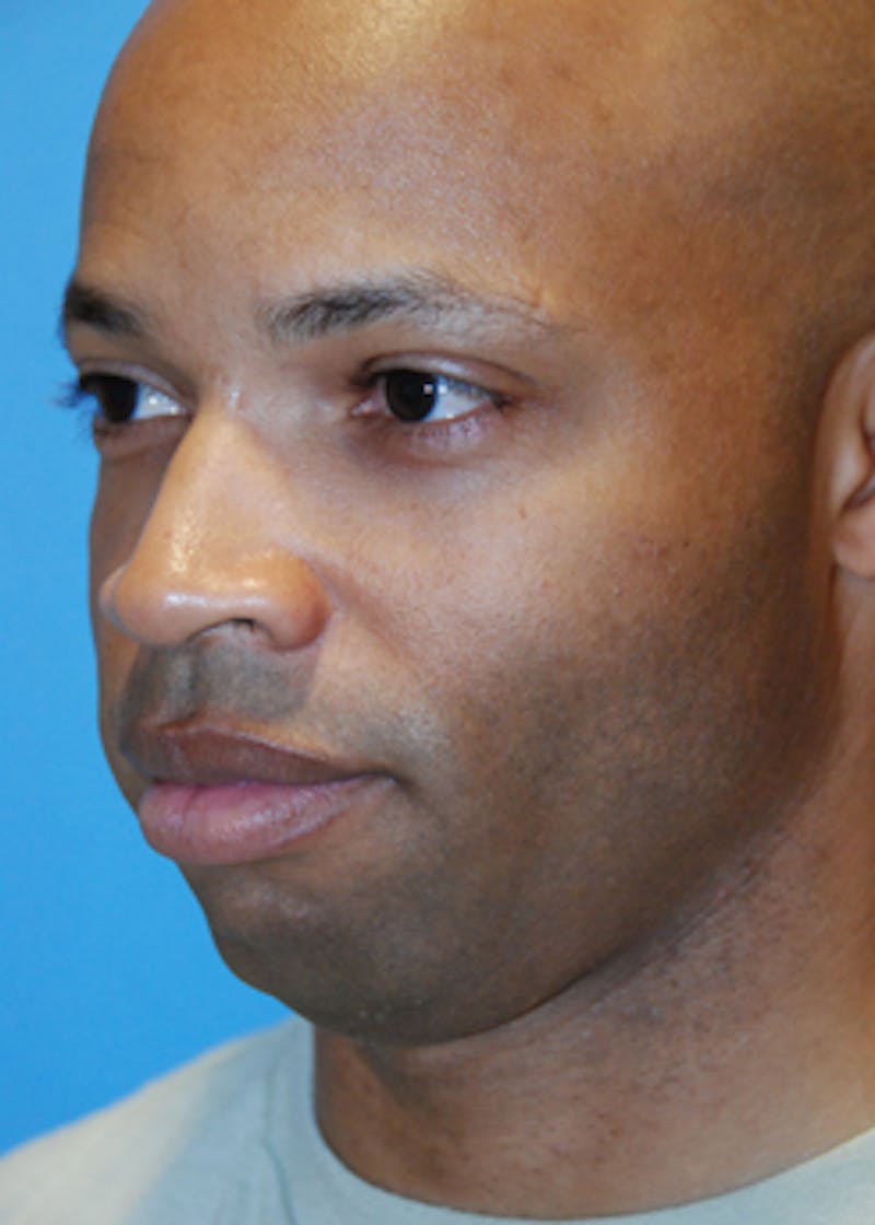 Chin Implant Reshaping Before & After Gallery - Patient 368668 - Image 1