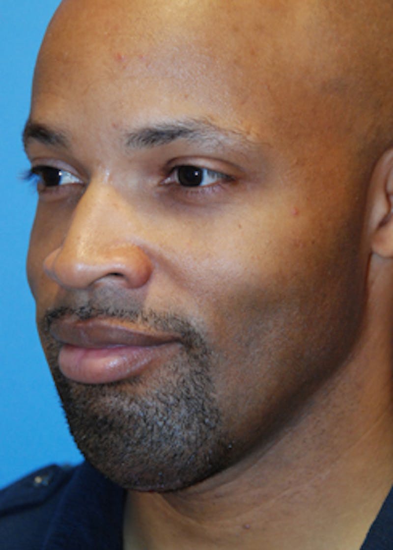 Chin Implant Reshaping Before & After Gallery - Patient 368668 - Image 2