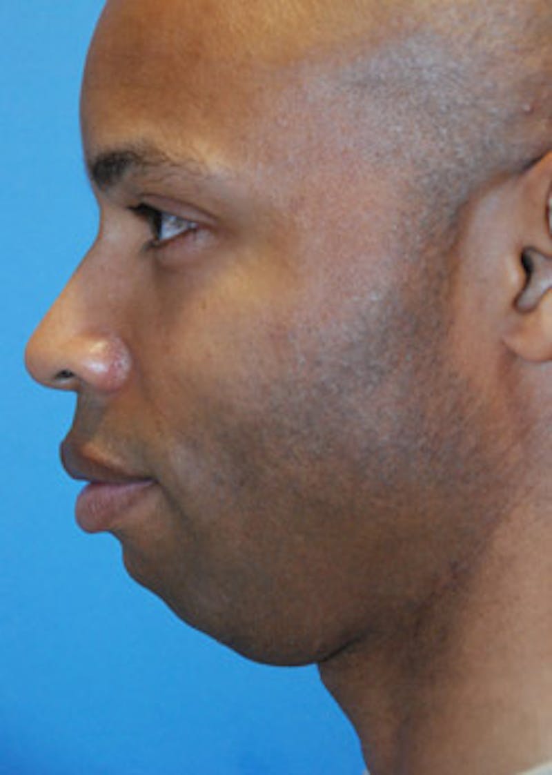 Facial Implants Before & After Gallery - Patient 189458 - Image 3