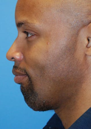 Facial Implants Before & After Gallery - Patient 189458 - Image 4