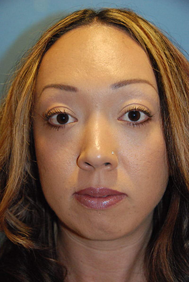 Facial Implants Before & After Gallery - Patient 199522 - Image 1