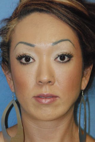 Chin Implant Reshaping Before & After Gallery - Patient 349261 - Image 2
