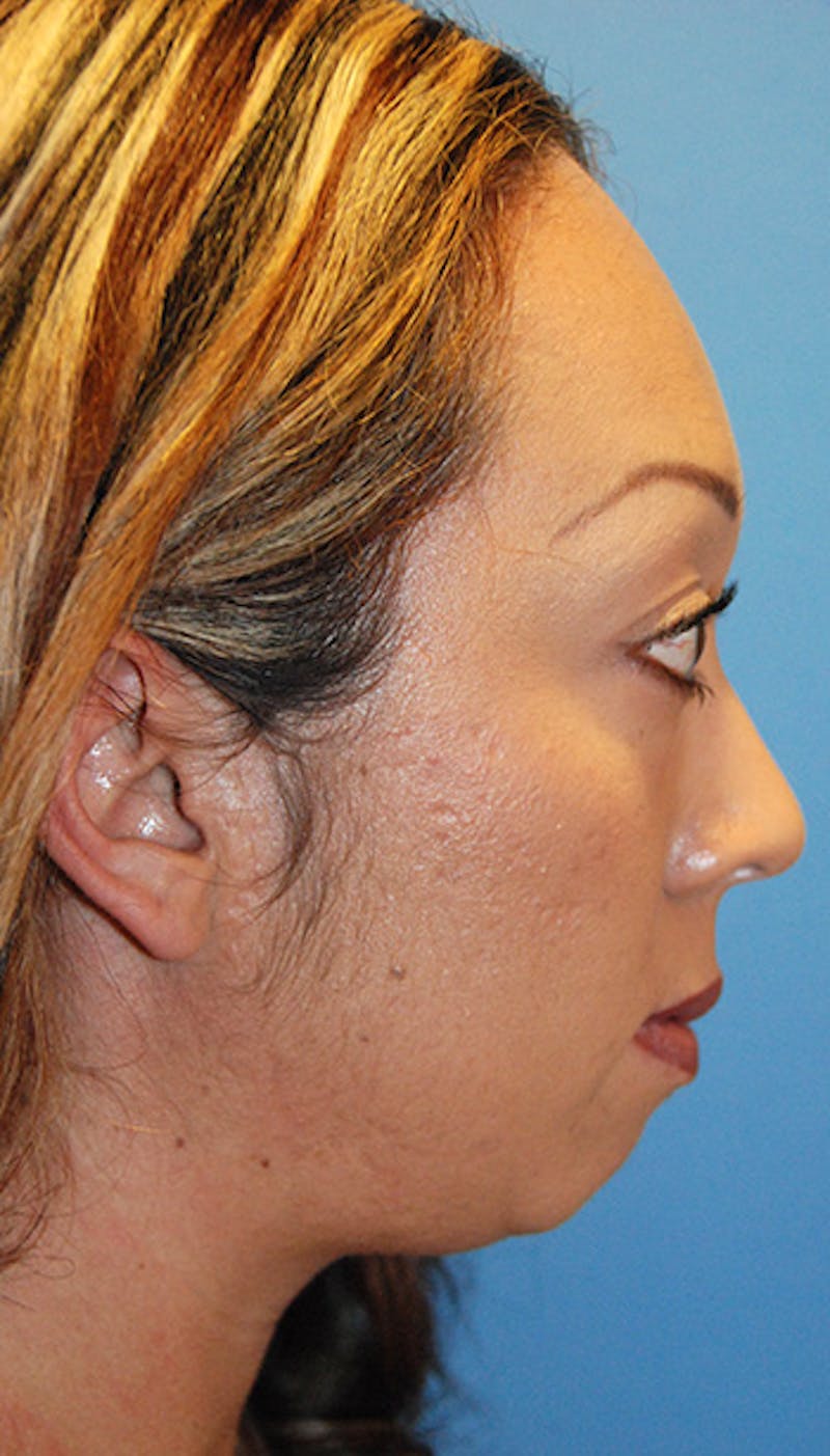 Facial Implants Before & After Gallery - Patient 199522 - Image 3