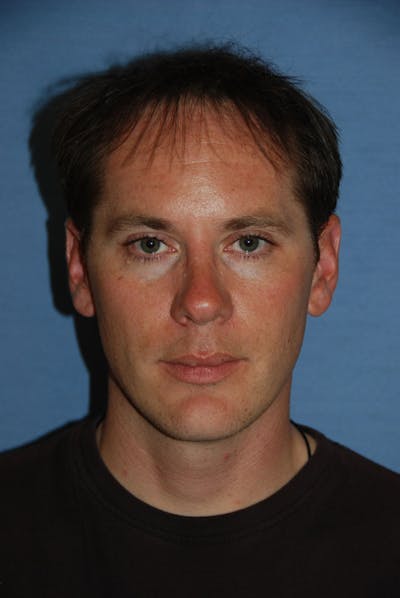 Rhinoplasty Before & After Gallery - Patient 194642 - Image 1