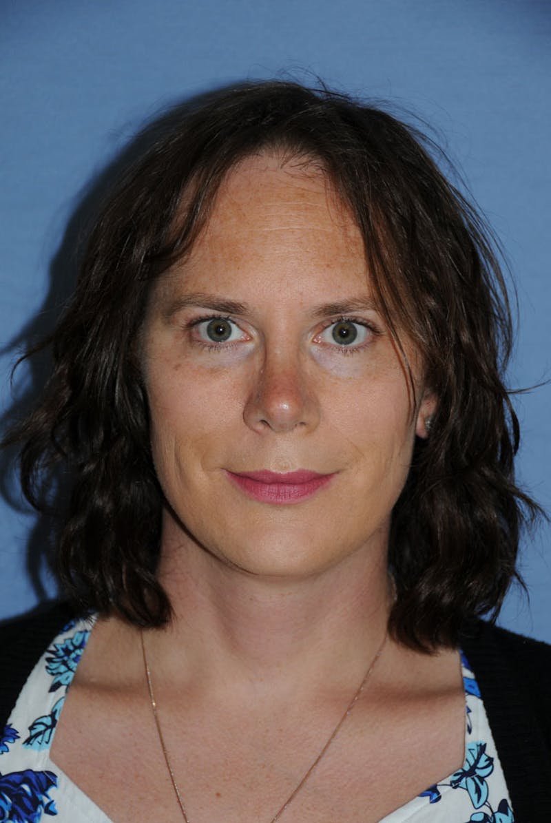 Transgender Surgery Before & After Gallery - Patient 238010 - Image 2