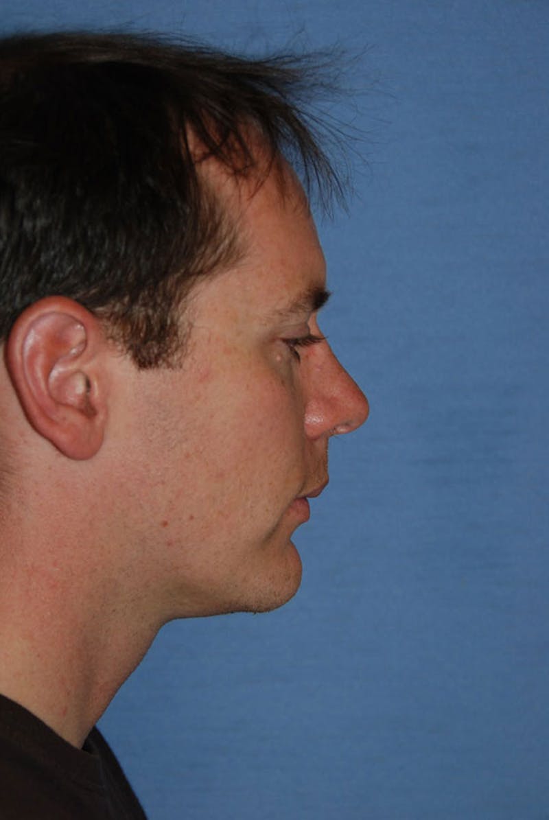 Transgender Surgery Before & After Gallery - Patient 238010 - Image 3