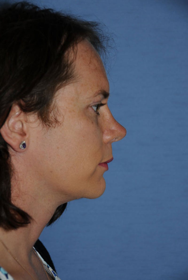 Transgender Surgery Before & After Gallery - Patient 238010 - Image 4