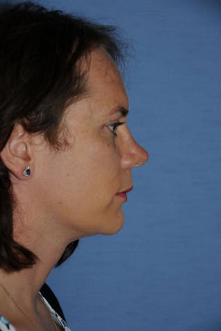 Chin Implant Reshaping Before & After Gallery - Patient 320129 - Image 4
