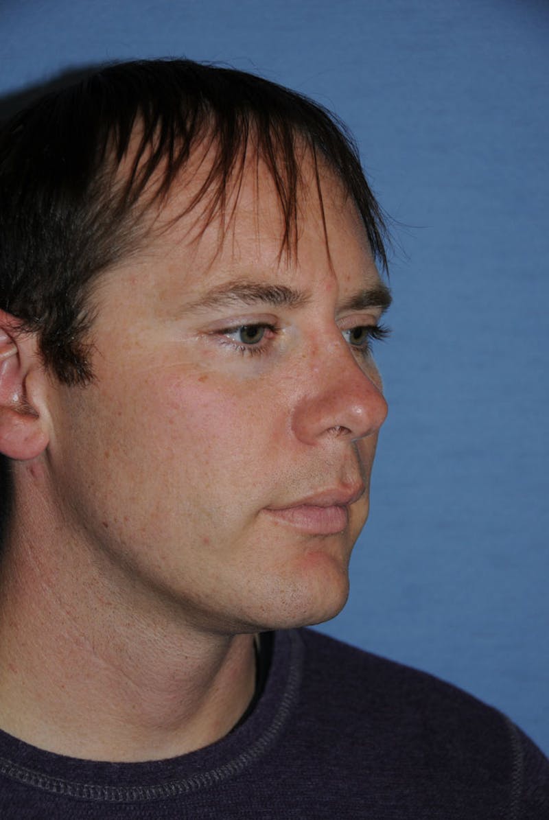 Transgender Surgery Before & After Gallery - Patient 238010 - Image 5