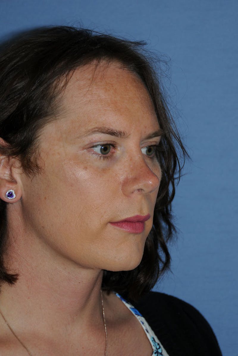 Transgender Surgery Before & After Gallery - Patient 238010 - Image 6