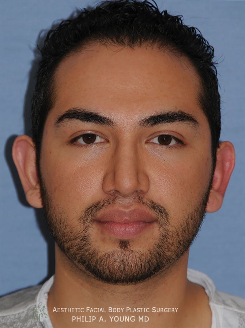 Ear Otoplasty Before & After Gallery - Patient 426050 - Image 1
