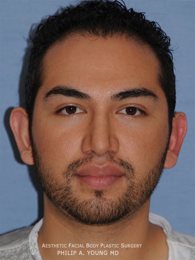 Ear Otoplasty Before & After Gallery - Patient 426050 - Image 1