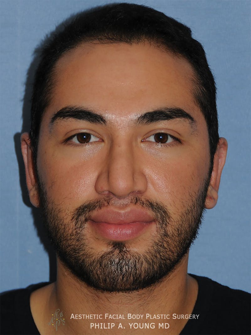 Ear Otoplasty Before & After Gallery - Patient 426050 - Image 2