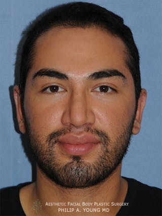 Ear Otoplasty Before & After Gallery - Patient 426050 - Image 2