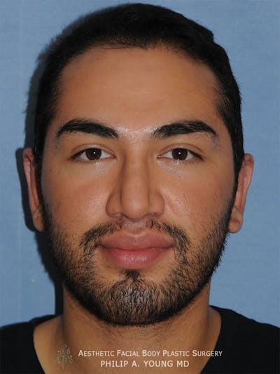 Ear Otoplasty Before & After Gallery - Patient 426050 - Image 2