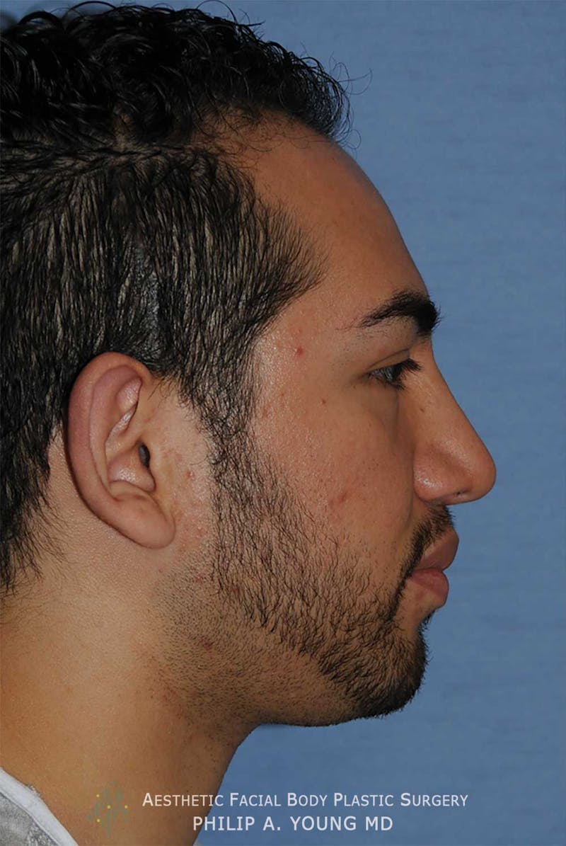 Ear Otoplasty Before & After Gallery - Patient 426050 - Image 3