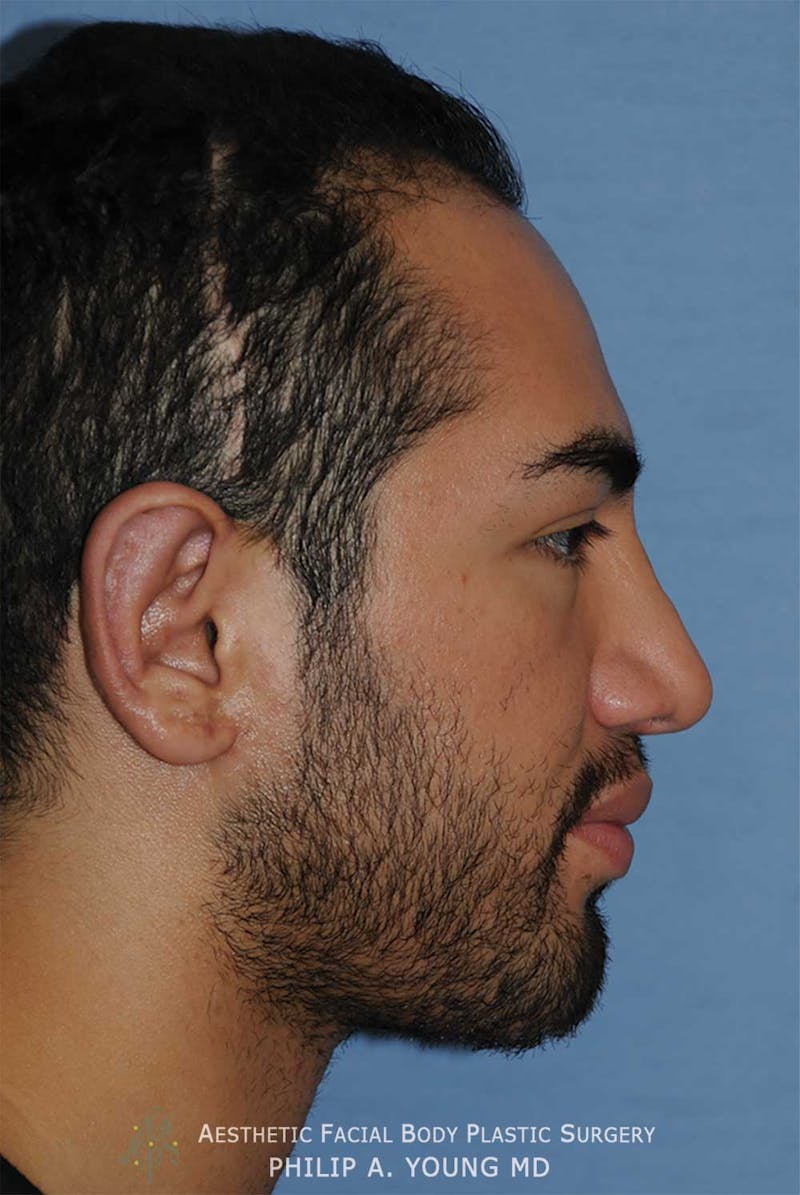 Ear Otoplasty Before & After Gallery - Patient 426050 - Image 4