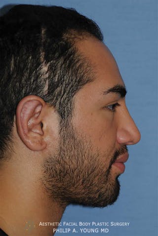 Ear Otoplasty Before & After Gallery - Patient 426050 - Image 4