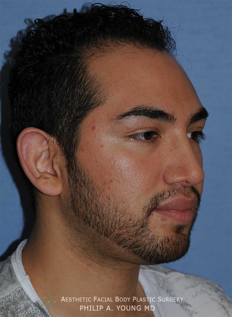 Ear Otoplasty Before & After Gallery - Patient 426050 - Image 5