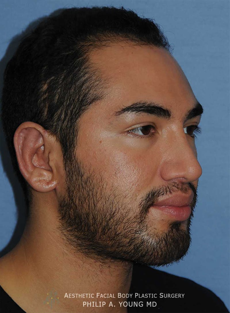 Ear Otoplasty Before & After Gallery - Patient 426050 - Image 6